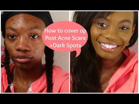 how to cover up acne scars