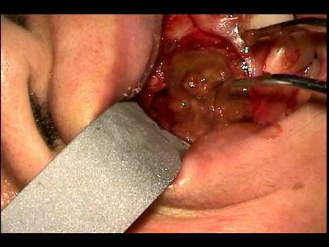 how to treat a periapical and a apex abscess on tooth