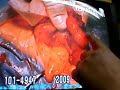 開腹手術