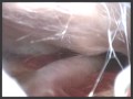 Arachnoid Cysts Endoscopic Treatment - Video 1 Arachnoid Cysts Endoscopic Treatment - Video 1