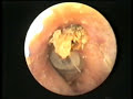 Otocerum 2 Tapones de cera en el oído - Reig Jofré