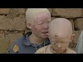 African albinos killed for body organs - 23 Jul 09
