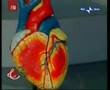 Prof. G. Di Sciascio Intervento di inserimento Stent Coronar