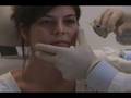 videos de Filler - Restylane Tear Troughs