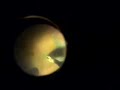 Macualr Hole & ILM peal Macualr Hole & ILM peal