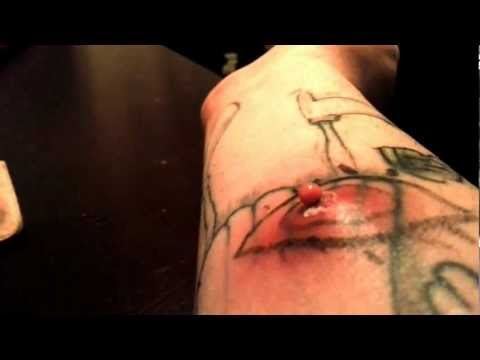how to treat spider bites nz