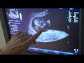 9 week ultrasound