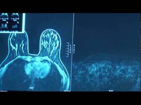 a history of detecting lung cancer at desert radiologists a history of detecting lung cancer at desert radiologists