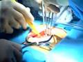 Live Webcast: Small Incision Mitral Valve Repair