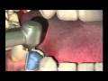 Crowns - Procedure for your new crown at Dental Reflections