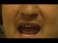 The Rain Song Video - Jordan Sweeney - Ulcerative Colitis  Ulcerative Colitis Crohn's Disease