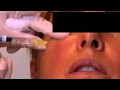 Correcting Wrinkles