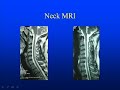 Neck Anatomy showing pinched nerves, disc ruptures & pain Neck Anatomy showing pinched nerves, disc ruptures & pain