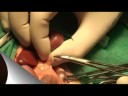 C�lculo ur�ter gata pseudoquiste perirrenal.mpg
