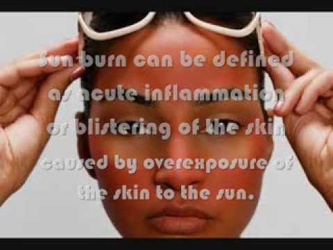 how to recover sunburn