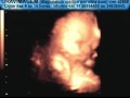 GRAVIMAGEM 951 (ULTRA-SOM 3D 4D GRAVIDEZ 31  SEMANAS)
