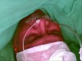 Atrial Septal Defect with Interstitial Lung Disease