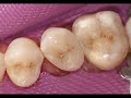 Dental Composite Resin Artistry