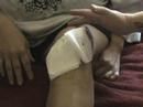 The Undressing of My Knee