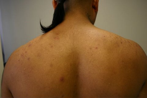The Acne Practice  (Back Acne 1)