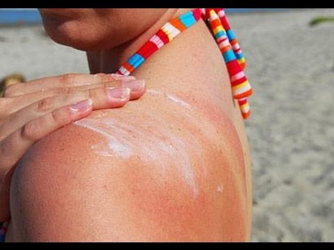 how to recover sunburn