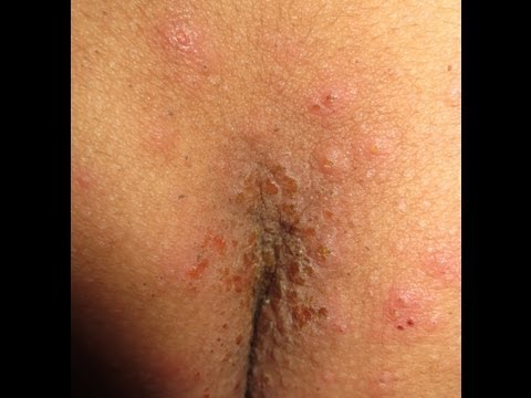 how to treat scabies
