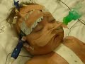 HLHS Ben Plinston Stage 2 Glenn operation