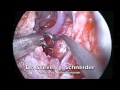 Brainstem Decompression by the Use of Endoscopic Transnasal and Intraoral Approach Brainstem Decompression by the Use of Endoscopic Transnasal and Intraoral Approach