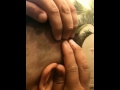 Ingrown hair popped