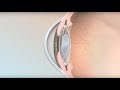 Intraocular Lenses - Mayo Clinic