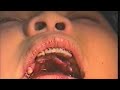 Maxillary Lingual Corticotomy Pt 1