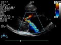 Color flow Doppler of systolic anterior motion of the mitral valve in a cat with severe hypertrophic cardiomyopathy. Note two turbulent jets originating from the same site - one extending into the aorta (dynamic subaortic stenosis) and the other into the left atrium (mitral regurgitation).