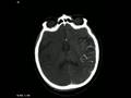 CT Angiogram of Stroke (Infarct, CVA)