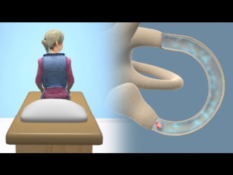 how to cure bppv vertigo