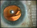 Cataract Surgery IOL Exchange by Uday Devgan MD Los Angeles Cataract Surgery IOL Exchange by Uday Devgan MD Los Angeles