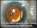 IOL Replacement - Cataract Surgery IOL Replacement - Cataract Surgery