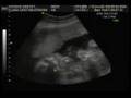 Ultração ULTRA-SONOGRAFIA - Futuro Bebê