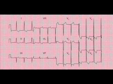 how to read ekg