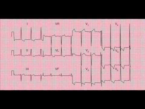 how to read an ekg