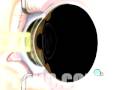 videos de Malpractice Medical PRK Laser Eye Surgery 3