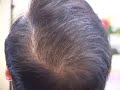 hair transplant close up:  crown reconstruction