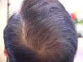 Hair transplant close-up:  crown reconstruction