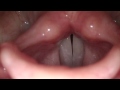 Female vocal cords vibrating during a stroboscopic rigid laryngoscopy exam. Normal amount of secretions. Small posterior gap between the vocal cords.