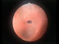 Broncoscopia (bronchoscopy) in anestesia locale.