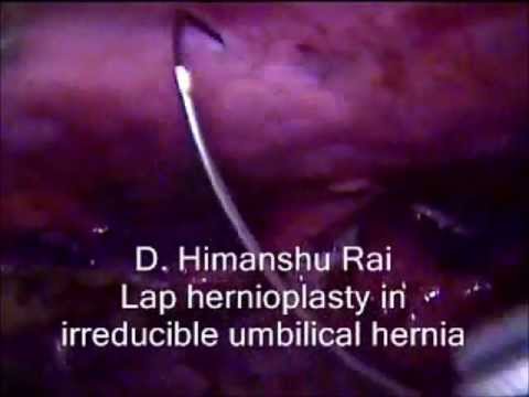 how to know if umbilical hernia is strangulated
