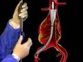 Podcast: Abdominal Aortic Aneurysm Repair