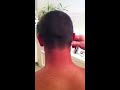 Nasty cyst removed from ear
