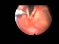 Laryngoscopy with Biopsy of Vocal Cord Laryngoscopy with Biopsy of Vocal Cord