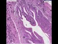 Histopathology Colon, rectum --Schistosomiasis