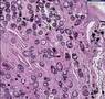 Histopathology Colon, rectum --Schistosomiasis